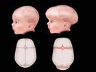 Assessment of the Newborn: Physical Anomalies and Neurologic Issues, Craniosynostosis and Hydrocephalus