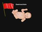 Assessment of the Newborn: Physical Anomalies and Neurologic Issues, Gastroschisis