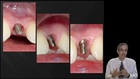 A-Z in Restorative Implant Dentistry, Maximizing Aesthetic Potential: Restorative Challenges and Goals with Ideal and Non-Ideal Implant Placement
