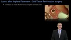 Lasers in Contemporary Implant Dentistry, Lasers in Contemporary Implant Dentistry - Part 2