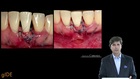 Severe Gingival Recession Treatment with Connective Tissue Grafts
