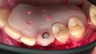 Single Tooth Esthetic Implant Replacement - From Diagnosis to Surgery to Final Restoration