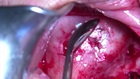 Sinus Elevation and GBR, Lateral Window - 2 Implants, 1 Post Extraction