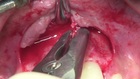 Anterior Implant Placement with Simultaneous GBR using Autogenous/Xenograft and Native Collagen Membrane