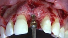 Esthetic Implant Placement with Simultaneous GBR and Soft Tissue Graft to Treat a Partially Failed Previous Bone Graft