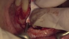 Staged Horizontal Ridge Augmentation using GBR in a Severely Resorbed Anterior Mandible