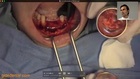 NARRATED Staged Horizontal Ridge Augmentation using GBR in a Severely Resorbed Anterior Mandible