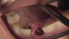 Immediate Tooth Replacement with Simultaneous Socket and Soft Tissue Graft