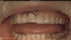 NARRATED Immediate Tooth Replacement with Simultaneous Socket and Soft Tissue Graft with Narration